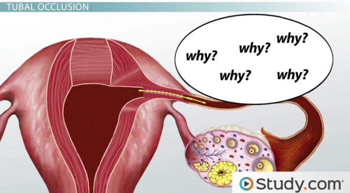 New Study Shows One in Fifty Women Who Have Been Sterilized Become Pregnant: What You Need to Know