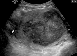 FDA Approves Ultrasound Device for Treating Uterine Fibroids