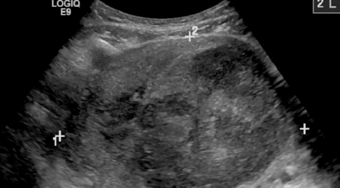 FDA Approves Ultrasound Device for Treating Uterine Fibroids