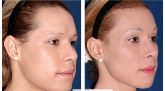 ¿Cuánto cuesta la cirugía de feminización facial? Guía de precios y factores