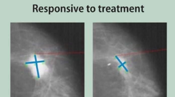 Estrogen Therapy May Reduce Mammogram Accuracy Study Finds