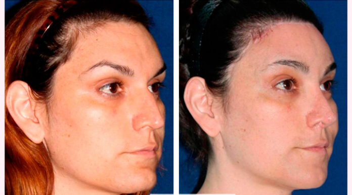 ¿Qué implica la cirugía de feminización de la mandíbula? Todo lo que debes saber