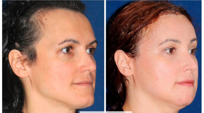 ¿Quién es el mejor cirujano de feminización facial? Ranking actualizado