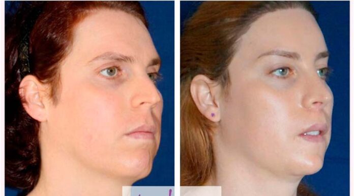 ¿Cómo puedo feminizar mi rostro? Opciones naturales y quirúrgicas