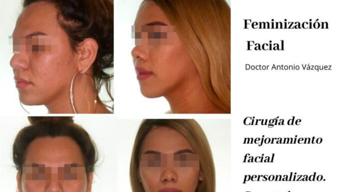 ¿El seguro cubre la cirugía de feminización facial? Guía práctica