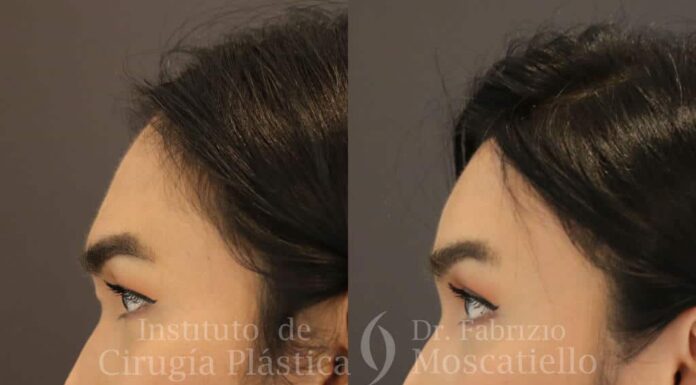 ¿Qué logra la cirugía de feminización facial? Más que cambios estéticos