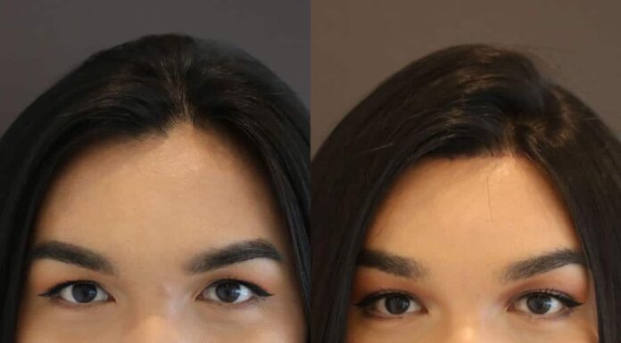 ¿Dónde hacerse una cirugía de feminización facial? Mejores clínicas