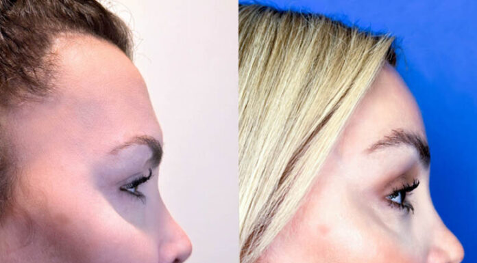 ¿Qué implica la cirugía de feminización de nariz? Procedimiento y recuperación