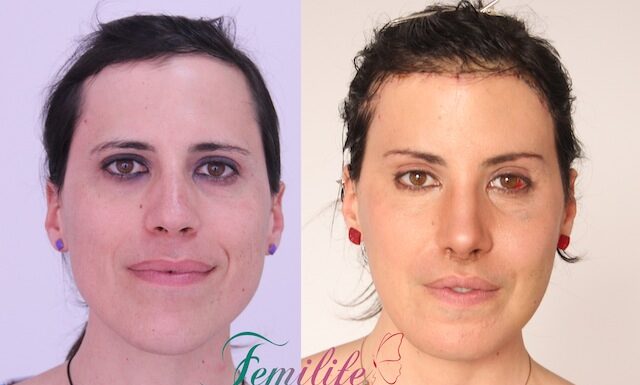 ¿Qué es la terapia hormonal de feminización? Cambios físicos y emocionales