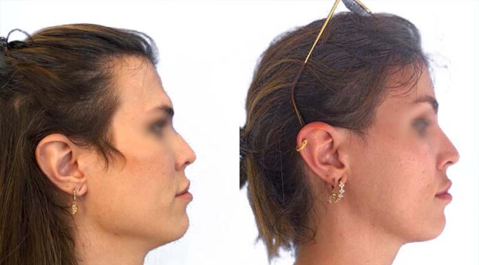 ¿Cuánto cuesta la cirugía de feminización mandibular? Guía de precios