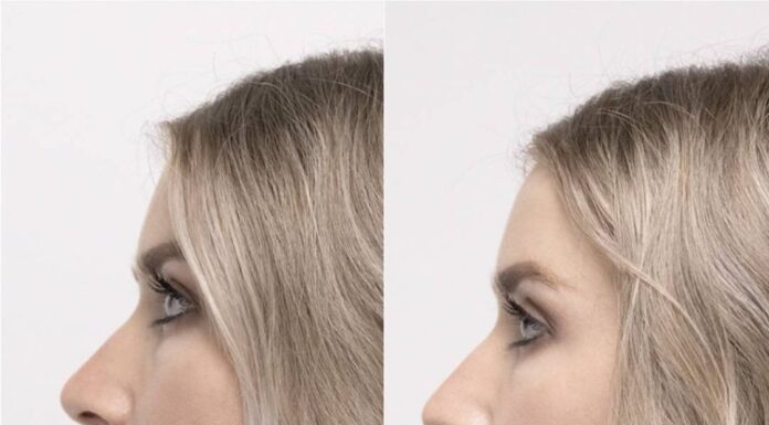 ¿Cómo feminizar el mentón? Opciones estéticas naturales y quirúrgicas